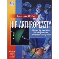 髋关节造形术：最低限度切入与电脑导航Hip Arthroplasty