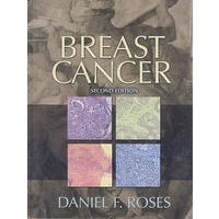乳癌（第2版）Breast Cancer